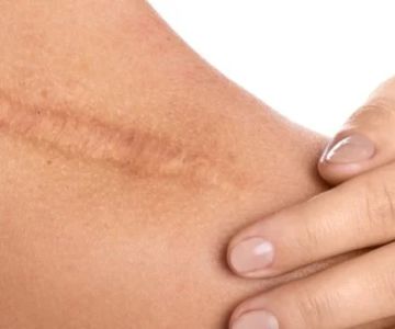 How to Repair Scars in People Over 40: A Comprehensive Guide