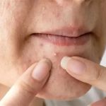 Effective Skin Care Tips for Whiteheads Using Natural Remedies