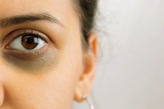 How To Prevent Your Dark Circles With These 7 Tips