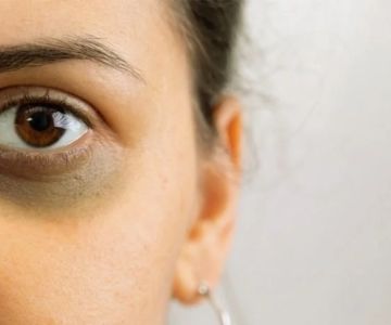 How To Prevent Your Dark Circles With These 7 Tips
