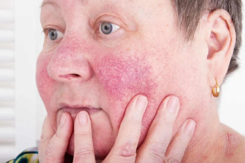 How To Heal Redness And How To Manage It Effectively