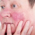 How To Heal Redness And How To Manage It Effectively