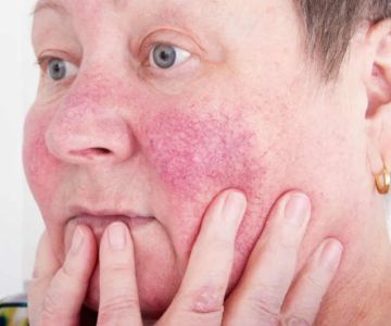 How To Heal Redness And How To Manage It Effectively