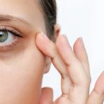 How to Deal with Dark Circles Using Natural Remedies: Effective Solutions
