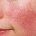 How To Soothe Redness Using Natural Remedies