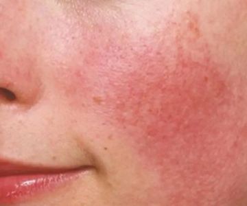 How To Soothe Redness Using Natural Remedies