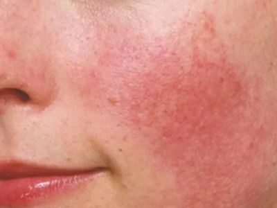 How To Soothe Redness Using Natural Remedies