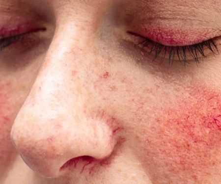 How to Choose the Right Way to Reduce Redness with These 7 Tips