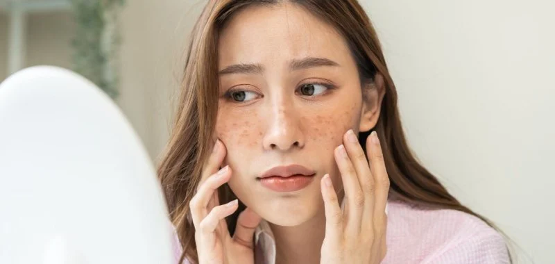 Tips For Sensitive Skin With Uneven Skin Tone: What You Need To Know