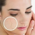Skin Care Tips For Acne In People With Dry Skin