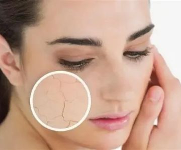 Skin Care Tips For Acne In People With Dry Skin