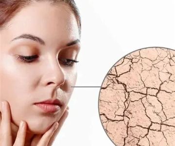How To Balance Your Dry Skin With These 10 Tips