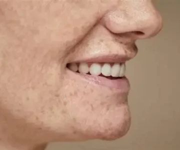 How To Avoid Retinol to Improve Age Spots Safely and Effectively