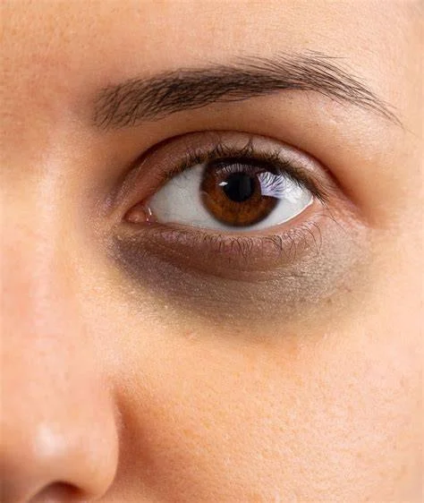 Best Ingredients For Your Dark Circles With These 7 Tips | Effective Solutions for Tired Eyes