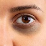 Best Ingredients For Your Dark Circles With These 7 Tips | Effective Solutions for Tired Eyes