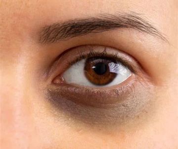 Best Ingredients For Your Dark Circles With These 7 Tips | Effective Solutions for Tired Eyes