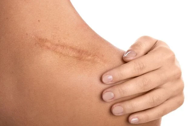 How to Avoid Scars: Essential Tips for Skin Care
