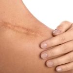 How to Avoid Scars: Essential Tips for Skin Care