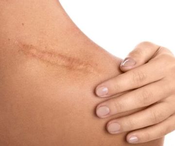 How to Avoid Scars: Essential Tips for Skin Care