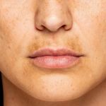 How To Repair Hyperpigmentation For New Mothers