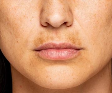 How To Repair Hyperpigmentation For New Mothers