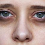 How to Effectively Repair Dark Circles in Athletes – Tips for Natural and Professional Treatments