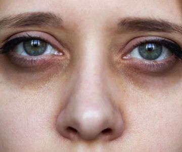 How to Effectively Repair Dark Circles in Athletes – Tips for Natural and Professional Treatments