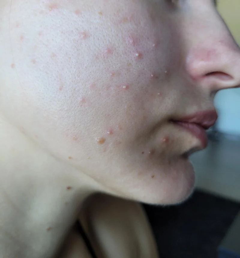 Tips for Sensitive Skin with Whiteheads: Effective Solutions for Clearer Skin