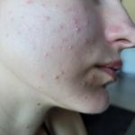 Tips for Sensitive Skin with Whiteheads: Effective Solutions for Clearer Skin