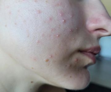 Tips for Sensitive Skin with Whiteheads: Effective Solutions for Clearer Skin