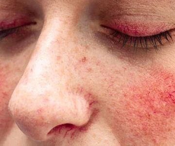How To Heal Redness Effectively