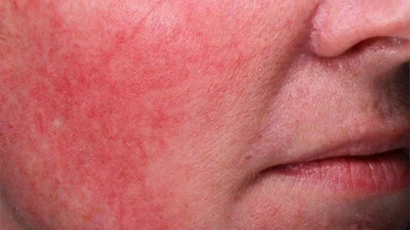 How To Avoid Inflamed Skin And How To Manage It