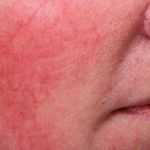 How To Avoid Inflamed Skin And How To Manage It