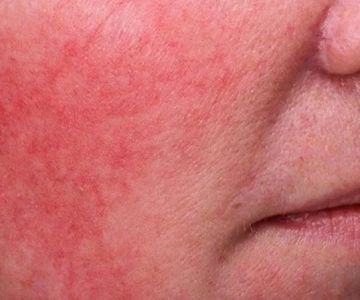 How To Avoid Inflamed Skin And How To Manage It