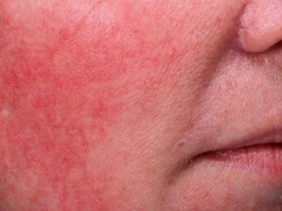 How To Avoid Inflamed Skin And How To Manage It