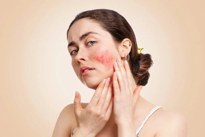 How To Brighten Rosacea Effectively - Safe and Proven Skin Care Tips