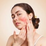 How To Brighten Rosacea Effectively - Safe and Proven Skin Care Tips