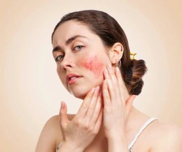 How To Brighten Rosacea Effectively - Safe and Proven Skin Care Tips
