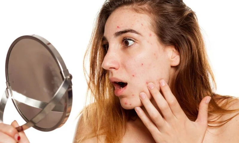 The Science Behind Acne And How To Manage It