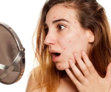 The Science Behind Acne And How To Manage It