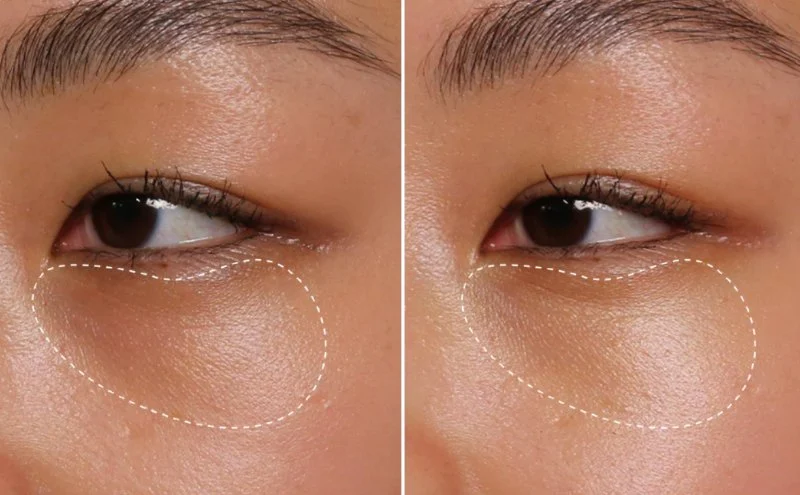 How To Prevent Dark Circles And How To Manage It