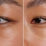 How To Prevent Dark Circles And How To Manage It