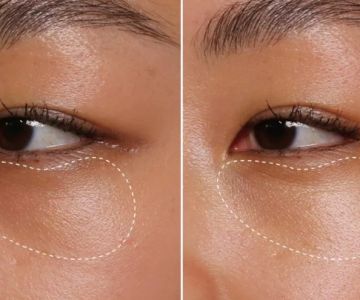 How To Prevent Dark Circles And How To Manage It