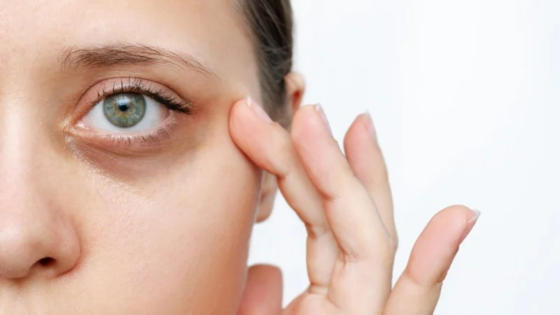 How to Achieve Your Dark Circles with These 7 Tips