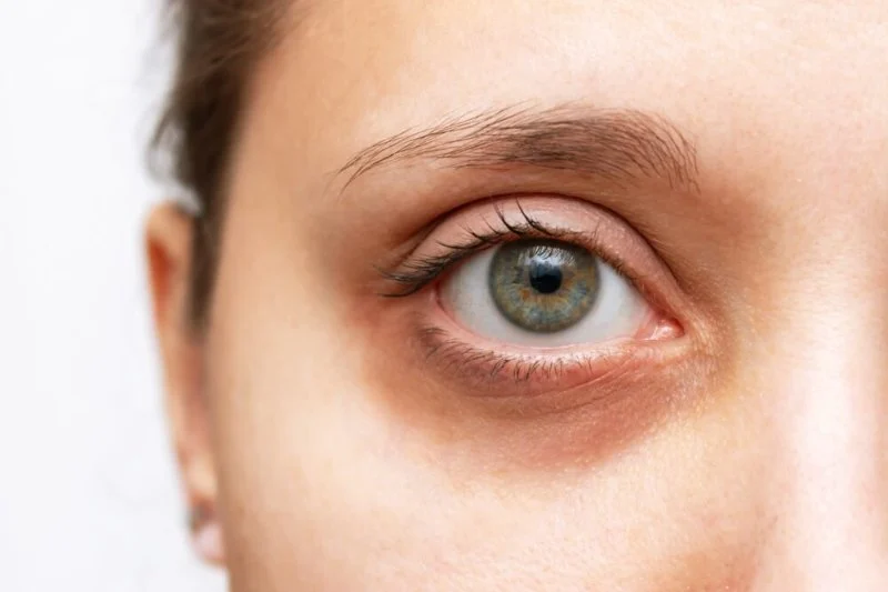 How to Effectively Heal Dark Circles and Brighten Your Under-Eye Area