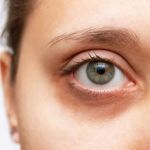 How to Effectively Heal Dark Circles and Brighten Your Under-Eye Area