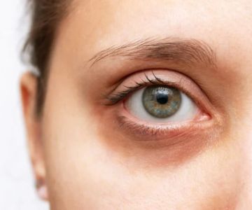 How to Effectively Heal Dark Circles and Brighten Your Under-Eye Area