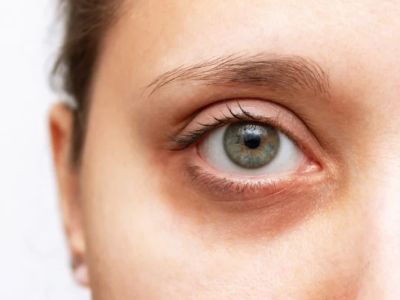 How to Effectively Heal Dark Circles and Brighten Your Under-Eye Area