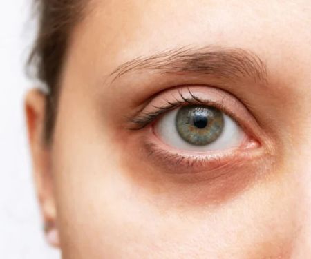 How to Effectively Heal Dark Circles and Brighten Your Under-Eye Area