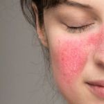 How To Avoid Rosacea: What You Need To Know